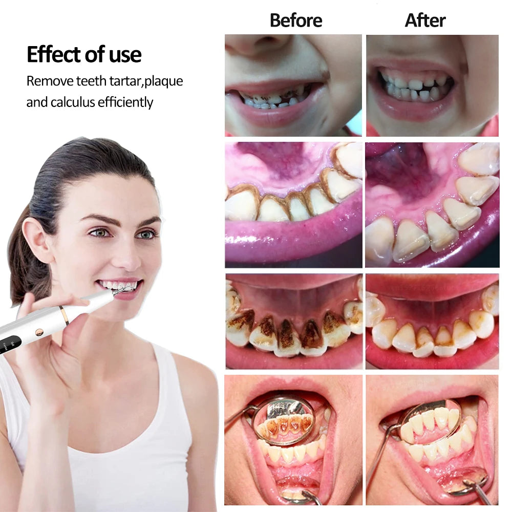 Ultrasonic Dental Calculus Remover Electric Tooth Stone Remover Professional Dental Cleaning at Home